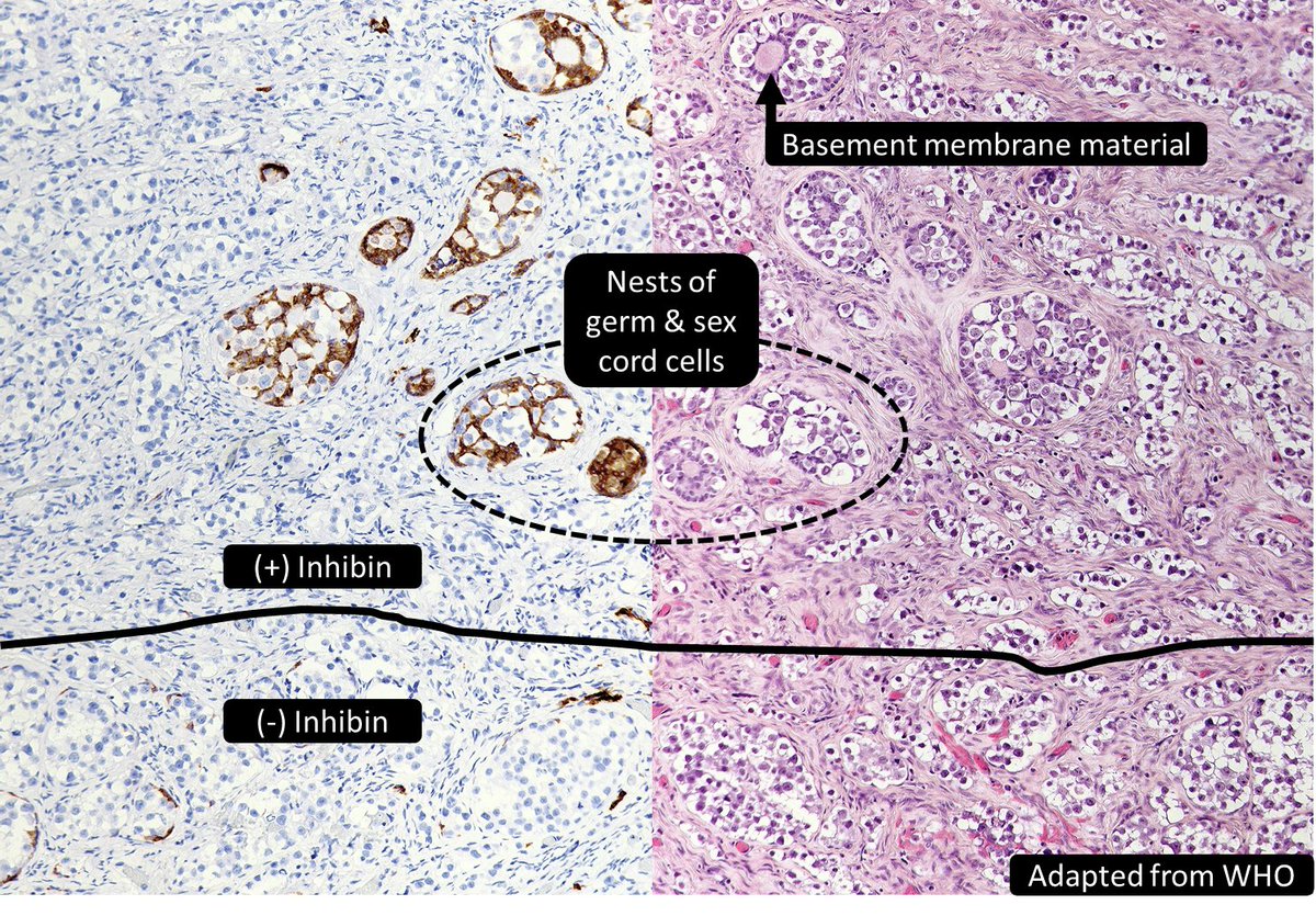 ___ of the ovary often presents in ___ syndrome
A) Gonadoblastoma
B) Gynandroblastoma
C) Sex Cord Tumor with Annular Tubules (SCTAT)
D) Sertoli Leydig Cell Tumor (SLCT)
#GYNPath #PediPath #PathResidents #PathTwitter
🥳#pathmatch24! 💪#pathmatch25!