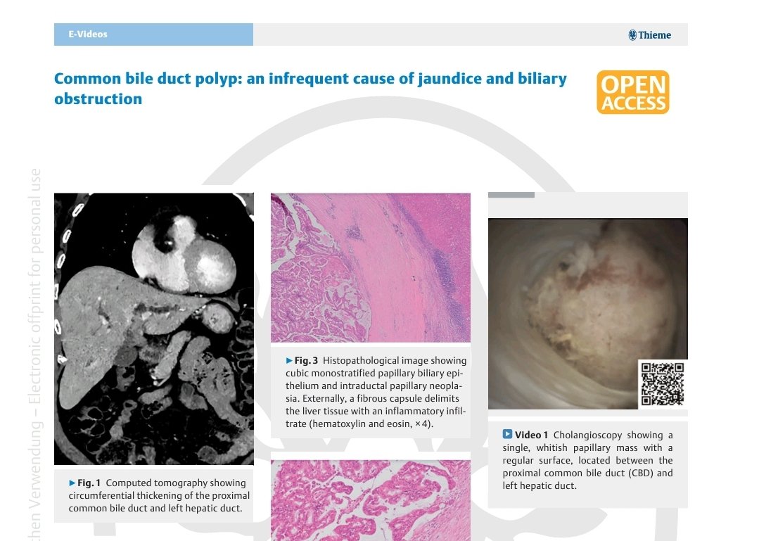 Edson Guzman (@gerlyedson) on Twitter photo Common bile duct polyp: an infrequent cause of jaundice and biliary obstruction
thieme-connect.de/products/ejour…
<a href="/endoscopyjrnl/">Endoscopy Journal</a> <a href="/RevGastroPeru/">RevGastroPeru</a> <a href="/sied_noticias/">SIED</a> <a href="/WorldGastroOrg/">World Gastroenterology Organisation (WGO)</a> <a href="/OPGEgastro/">Organización Panamericana de Gastroenterología</a> <a href="/japariciot2/">José Ramón Aparicio</a> <a href="/DHgua/">Digestivo HGUA</a> <a href="/EndoscopiaH/">EndoscopiaHGUA</a> <a href="/SEEDendoscopia/">SEED</a> <a href="/AmCollegeGastro/">ACG</a> <a href="/AmJGastro/">AJG - The American Journal of Gastroenterology</a> Common bile duct polyp: an infrequent cause of jaundice and biliary obstruction
thieme-connect.de/products/ejour…
<a href="/endoscopyjrnl/">Endoscopy Journal</a> <a href="/RevGastroPeru/">RevGastroPeru</a> <a href="/sied_noticias/">SIED</a> <a href="/WorldGastroOrg/">World Gastroenterology Organisation (WGO)</a> <a href="/OPGEgastro/">Organización Panamericana de Gastroenterología</a> <a href="/japariciot2/">José Ramón Aparicio</a> <a href="/DHgua/">Digestivo HGUA</a> <a href="/EndoscopiaH/">EndoscopiaHGUA</a> <a href="/SEEDendoscopia/">SEED</a> <a href="/AmCollegeGastro/">ACG</a> <a href="/AmJGastro/">AJG - The American Journal of Gastroenterology</a>