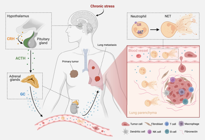 Stress-induced metastasis: The NET effect dlvr.it/T47r5v