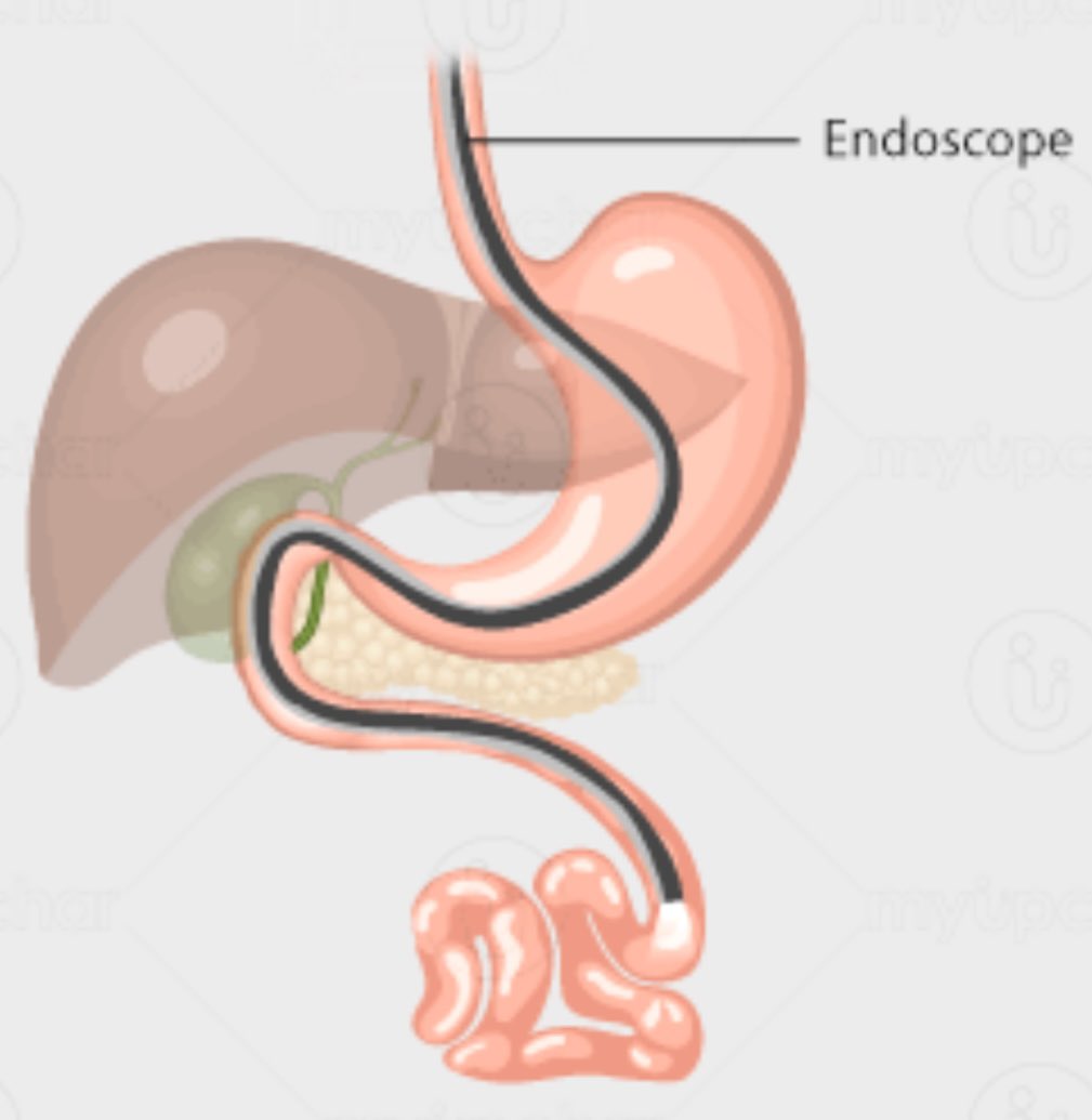 Colonoscopy can be performed w/o sedation (eg patient request due to fear of anesthesia)— np. Recently performed a colonoscopy PLUS enteroscopy (antegrade) w/o sedation. Remarkable experience (ended well🤞🏼). Curious, is enteroscopy routinely performed w/o sedation anywhere?