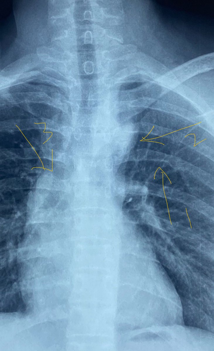 1. Rib notching 2. Prominent left subclavian leading to 3 sign and 3. Ascending aortic dilatation (associated aortopathy of BAV or hypertension)