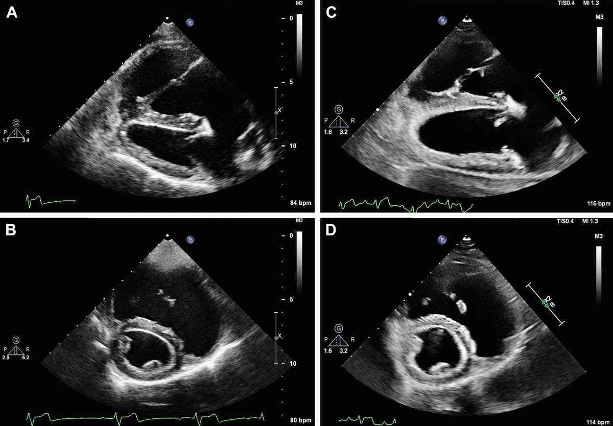 ASE360's tweet photo. Atrial septal defect is a common congenital heart defect in people. However, the prevalence of ASD in dogs is much less common, generally reported to be around 2%.
Read our @CASEfromASE report: https://t.co/7EUEUqyy1i
#CASESpecialIssue #10DaysofCASE #ACHD https://t.co/6bdT3W2AUl