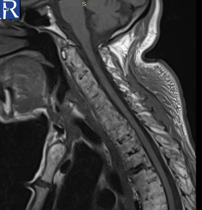 A 77-year-old individual with #ankylosing #spondylitis was admitted following a fall from a lower level. #radiology #mskrad #mskradiology #radtwitter #Neurosurgery #rheumatology #medstudent #MedTwitter #radres #futureradres #radiologist #rheumatologist