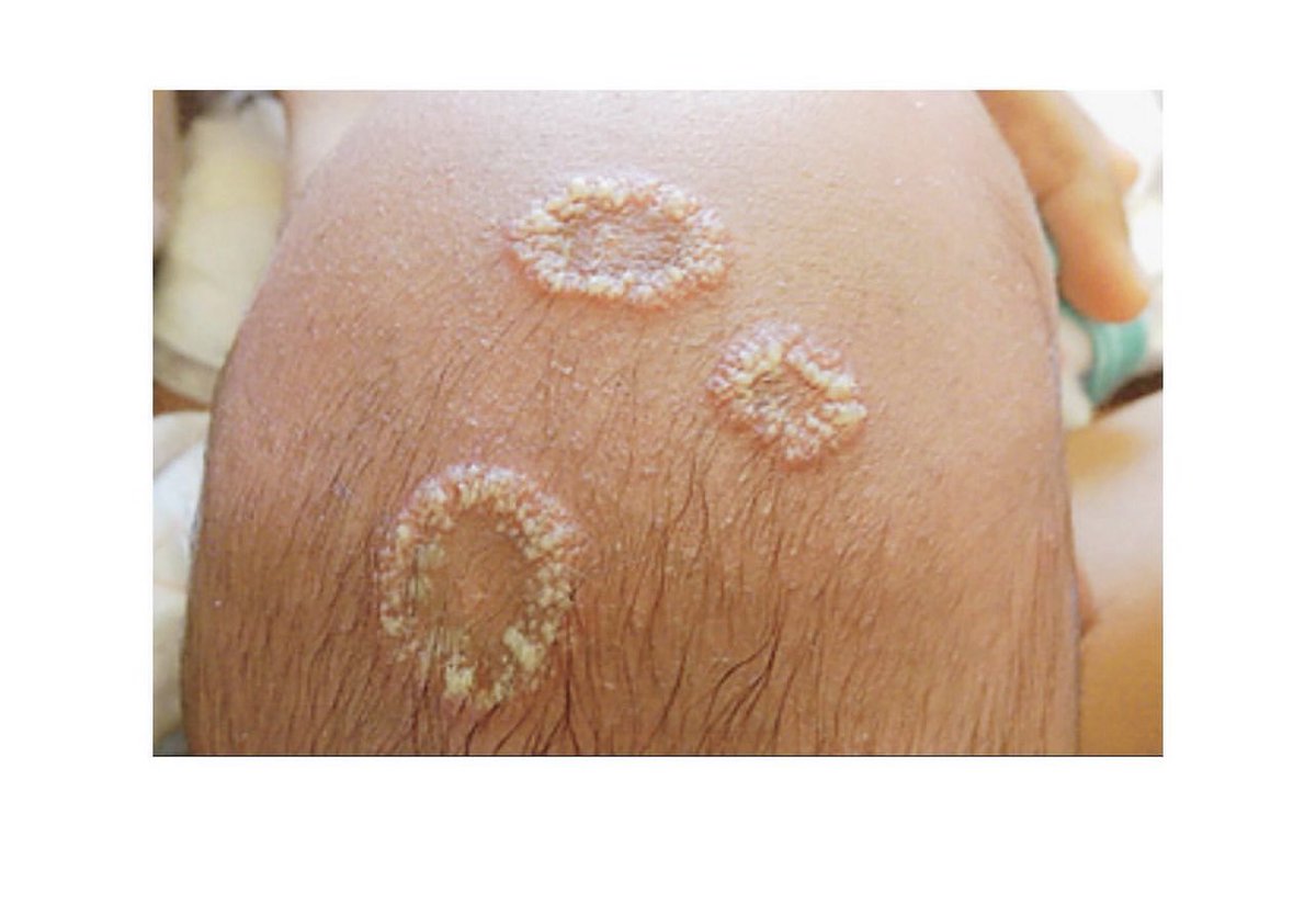 DrMedica_13's tweet photo. #DermaMed🦠
The baby's mother, who was originally from Somalia, had similar skin lesions on her upper trunk.
What is the “diagnosis”?
#Diagnosis #MedEd #MedX https://t.co/optPpK7X8s