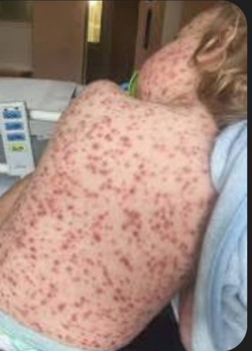 Since the pandemic and all the anti-vax conspiracy theories flooded the internet, measles rates in Europe have increased by 30 times. There are consequences to allowing lies to spread freely through social media. #VaccinesWork #Vaccine