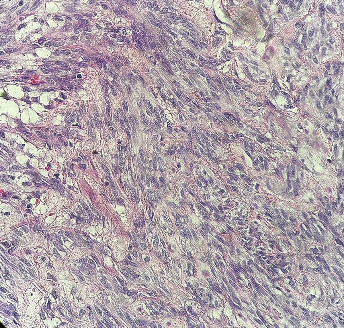 I arise from the interstitial cells of Cajal

I am a (relatively) common soft tissue neoplasm in the stomach

I can be treated with Gleevec

Who am I?

#pathagonia #pathx #medstudentx #gensurg #surgonc #hemeonc #surgpath #gipath #gastroenterology #medx #medtwitter #pathtwitter
