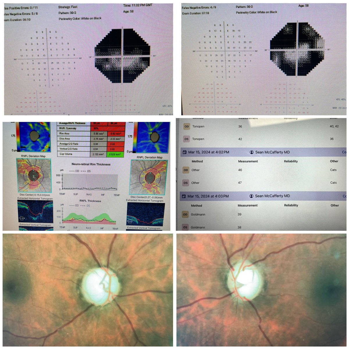 Friday's patient: 58 yo first ocular exam with 20/80 OU. #glaucomaawareness