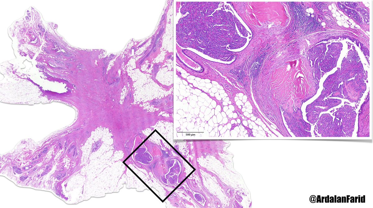 Farid Azmoudeh-Ardalan (@ardalanfarid) on Twitter photo The image shows a #breast lesion. What’s you diagnosis?
#QuizTime 
#PathTwitter 
#Breast_pathology The image shows a #breast lesion. What’s you diagnosis?
#QuizTime 
#PathTwitter 
#Breast_pathology