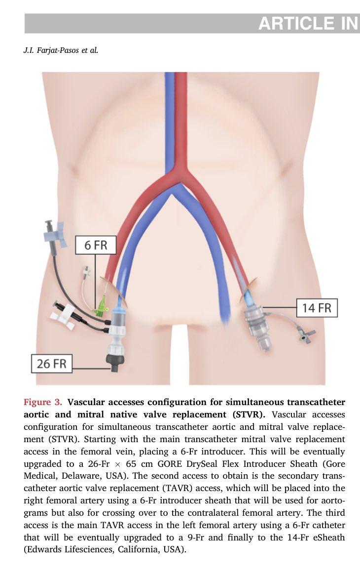 Julio Farjat Pasos (@julio_farjat) on Twitter photo Simultaneous #TAVR (AR) + #TMVR (MAC) (#STVR) in native valve disease:
A Step-by-Step Procedural Approach.
Now available in #StructuralHeart journal <a href="/crfheart/">Cardiovascular Research Foundation</a> #Cardiology #interventionalcardiology
👇🏻
structuralheartjournal.org/article/S2474-… Simultaneous #TAVR (AR) + #TMVR (MAC) (#STVR) in native valve disease:
A Step-by-Step Procedural Approach.
Now available in #StructuralHeart journal <a href="/crfheart/">Cardiovascular Research Foundation</a> #Cardiology #interventionalcardiology
👇🏻
structuralheartjournal.org/article/S2474-…