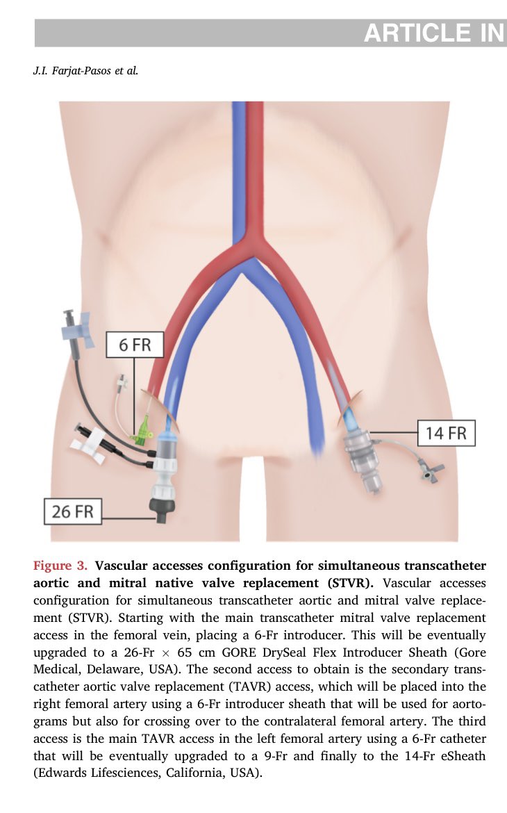 Simultaneous #TAVR (AR) + #TMVR (MAC) (#STVR) in native valve disease: A Step-by-Step Procedural Approach. Now available in #StructuralHeart journal @crfheart #Cardiology #interventionalcardiology 👇🏻 structuralheartjournal.org/article/S2474-…