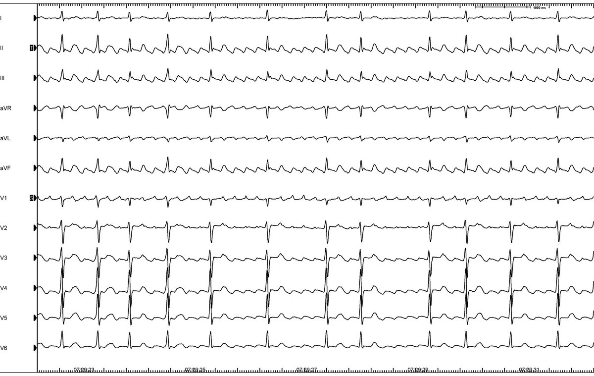 Textbook #ecg of different CTI dependent atrial flutter: 1&2) 🕰️wise (II, III, aVF positive, V1 negative, rounder P waves) ↔️ 3) counter🕰️wise (II, III, aVF negative, V1 positive, sawtooth 🪚 🦷 P waves) for #Epeeps #CardioTwitter #Cardiology #Fellowsfirst #EmergencyRoom #EKG