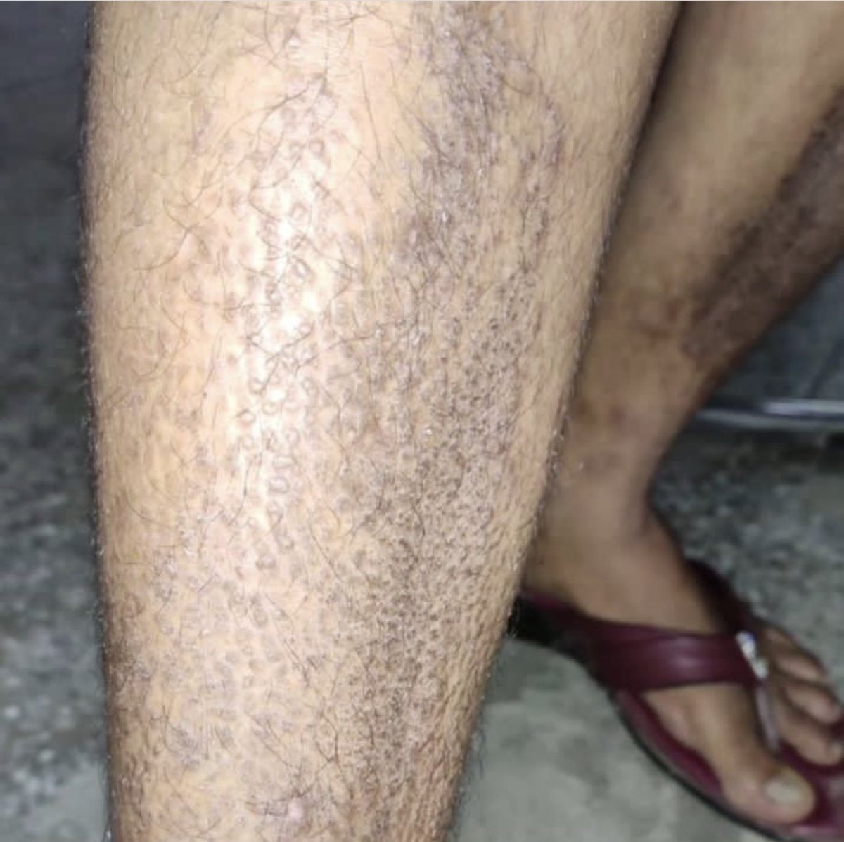 DrMedica_13's tweet image. #Clinical_Case🦠

Itchy papules only over bilateral shins in an adult female patient for the last 1 year.
No family or personal past history of similar illness. 

What are your #differentials?

#Diagnosis #MedEd #MedX