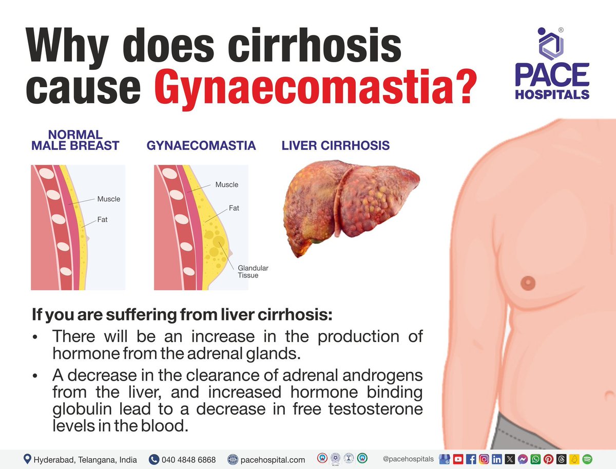 #Gynecomastia is a condition of enlarged or overdeveloped #malebreasts. It is caused by an imbalance of the hormones testosterone and estrogen.

Know more: bit.ly/3RnvIEZ

#gynecomastiamanagement #plasticsurgery #gynecomastiasurgeon #pacehospitals #hyderabad #india