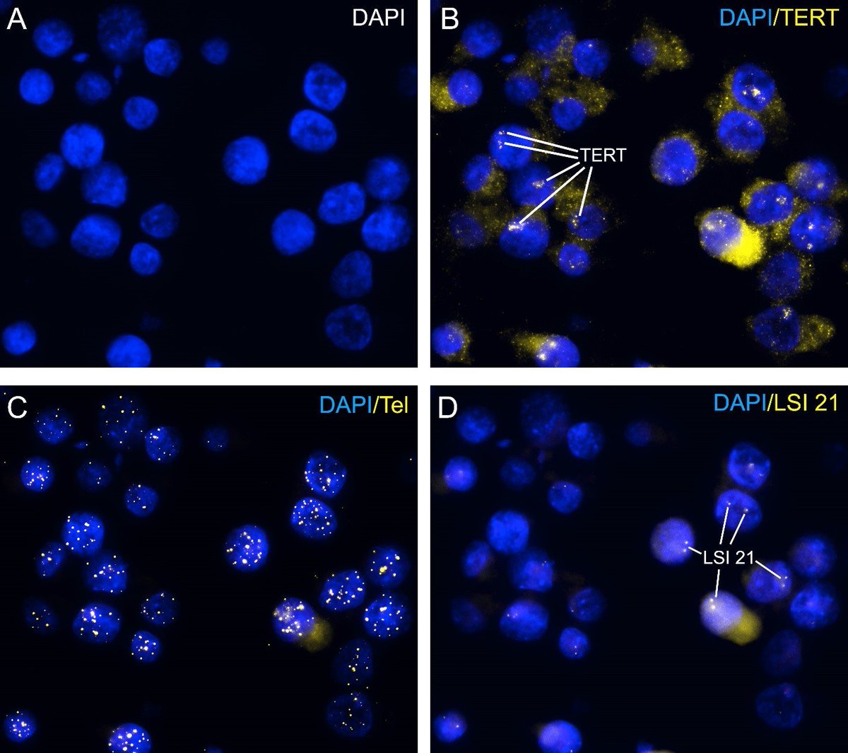 LIDSEN_Publish's tweet photo. #LIDSEN #OBMGenetics
Special Issue from Open for Submissions:
📗Applications of Fluorescence in Situ Hybridization II.
🔆Guest edited by Thomas Liehr, PhD
🔗https://t.co/Q2spqbOfxE
#Technology #Gene #Genome #Telomerase https://t.co/KTNHNpx4jG
