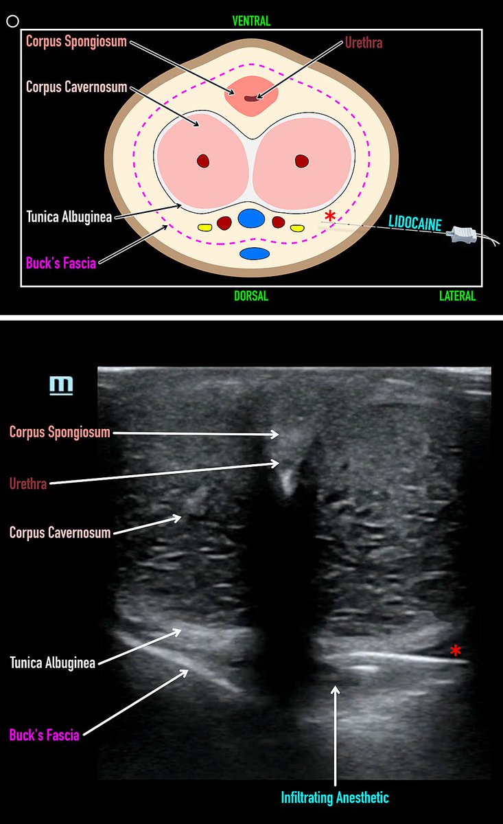 Ultrasound-Guided Priapism Management?! Block + aspirate/inject with #POCUS to optimize success and minimize injury! Read case report (temporary free link), pearls, infographics & clips below! authors.elsevier.com/a/1iqvR2dHVQCl… #FOAMed @ACEP_EUS @SCUFellowships @SAEMAEUS @BrianMakowski