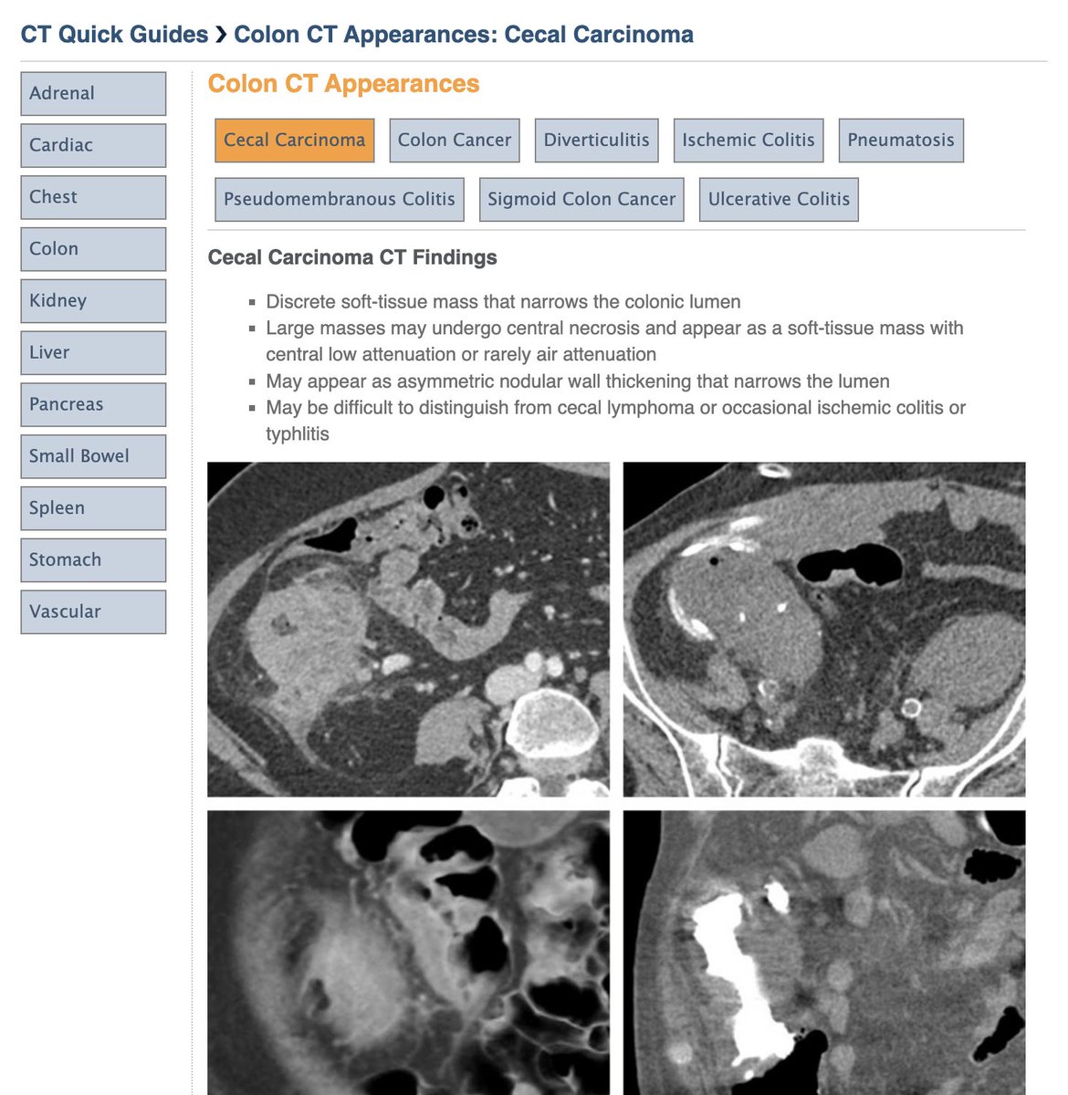 We just added 8 colon pathologies to our CT Quick Guides ctisus.com/learning/featu…