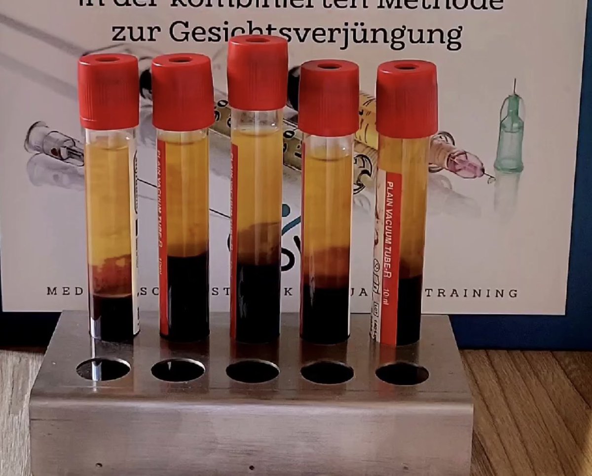 Drrichbicon's tweet photo. @InformaCosmos Excelente información, acabamos de hacer un entrenamiento con dos expertos en biología y regeneración con CGF (factores de crecimiento concentrados) https://t.co/QZOuoHmqcT