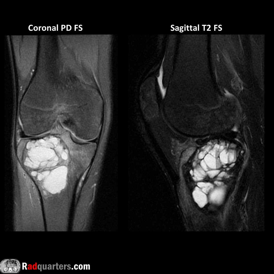Giant cell tumor of proximal tibia. Eccentrically located at end of long bones (epiphysis + metaphyseal extension). Closed growth plates. Ages 20-40. +/- fluid-fluid levels, can co-exist with aneurysmal bone cyst. Rarely malignant but locally aggressive. #FOAMrad #radres #mskrad