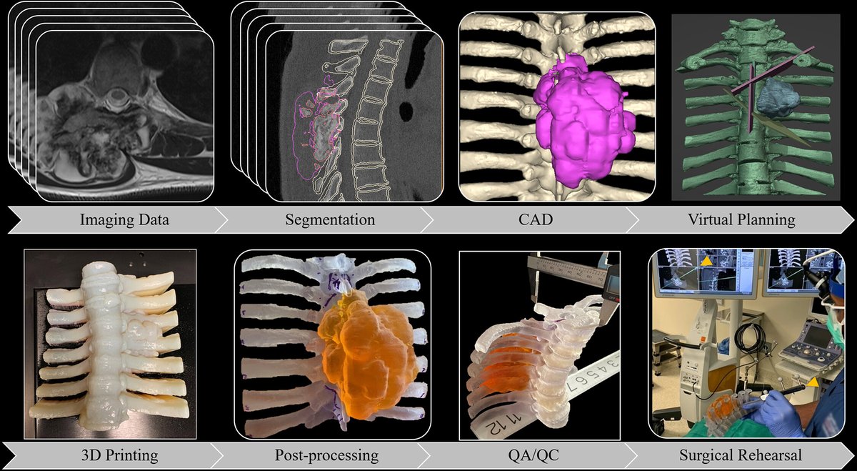 Learn how 3D printed models can help surgeons develop, test, and refine plans for complex spine surgery by providing opportunity for surgical rehearsal. bit.ly/49f8hGO