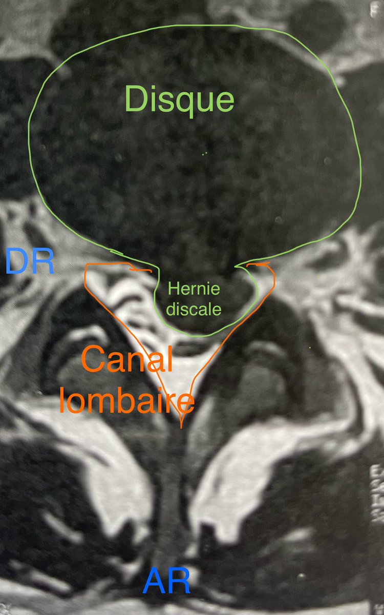 Encore une grosse hernie discale lombaire L3L4. Opérée en urgence pour déficit. La taille du fragment m’a fait demandé si le patient avait été manipulé. Réponse: OUI & avec radiculalgie ET déficit 🫣.🚩🚩 Et 2 fois Ostéopathe sans avis du médecin Le stagiaire a apprécié