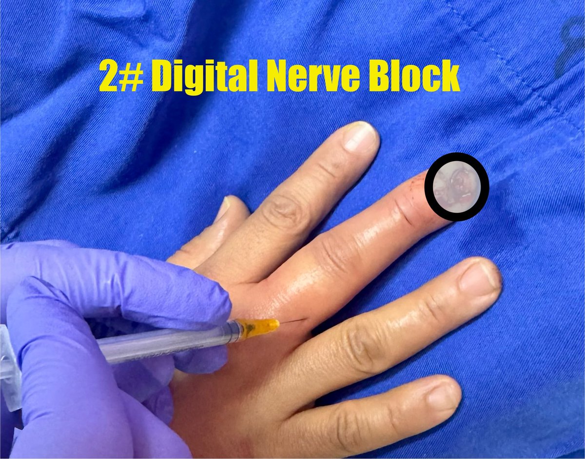 bouaggad_abdu's tweet photo. Simple block for unusual complicated injury #1 
Digital Nerve Block simple efficient and reliable 
#MedTwitter #Afsra @AFSRA10 @ASRA_Society #medicalstudent #Emergency @AnesthesiaCons1 @khattouamine @Abelgavino https://t.co/cl5pUIcYGf