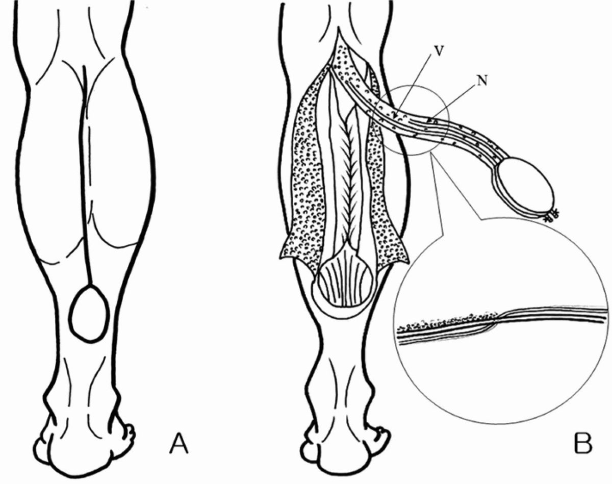 SURAL NEUROMA IN PROXIMALLY‐BASED SURAL ARTERY FLAP 

Old flap for proximal leg ulcer, presented with pain. US shows neuroma of the sural nerve. Lesser spahenous vein and sural artery follow the nerve. Vein and Nerve could be traced up the popliteal fossa to their normal anatomic