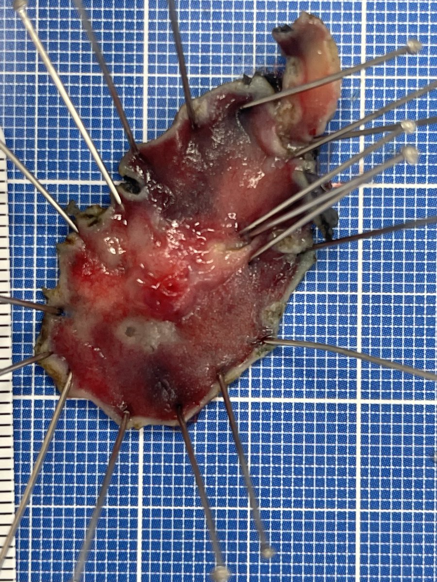 Emerging approach utilizing Endoscopic submucosal dissection for residual lesions/regrowths after locally advanced rectal cancers treated with TNT providing improvements in organ preservation. @fascrs_tech @MidwestSurgical @CentralSurg @SSATNews