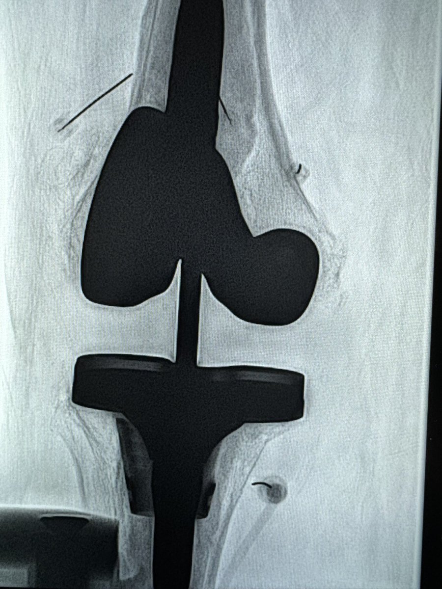 Shashi Murthy (@shashimurthymd) on Twitter photo Seeing patient for 2 month follow-up after genicular nerve ablation for chronic knee pain post arthroplasty. Went from walking with a cane to ambulating without assistance and joining a gym. Thoughts on when to offer #Coolief versus #GAE. <a href="/SandeepBaglaMD/">Sandeep Bagla MD</a> <a href="/johnsmirnMD/">John Smirniotopoulos</a> <a href="/SidpadiaIR/">Sid Padia</a> Seeing patient for 2 month follow-up after genicular nerve ablation for chronic knee pain post arthroplasty. Went from walking with a cane to ambulating without assistance and joining a gym. Thoughts on when to offer #Coolief versus #GAE. <a href="/SandeepBaglaMD/">Sandeep Bagla MD</a> <a href="/johnsmirnMD/">John Smirniotopoulos</a> <a href="/SidpadiaIR/">Sid Padia</a>