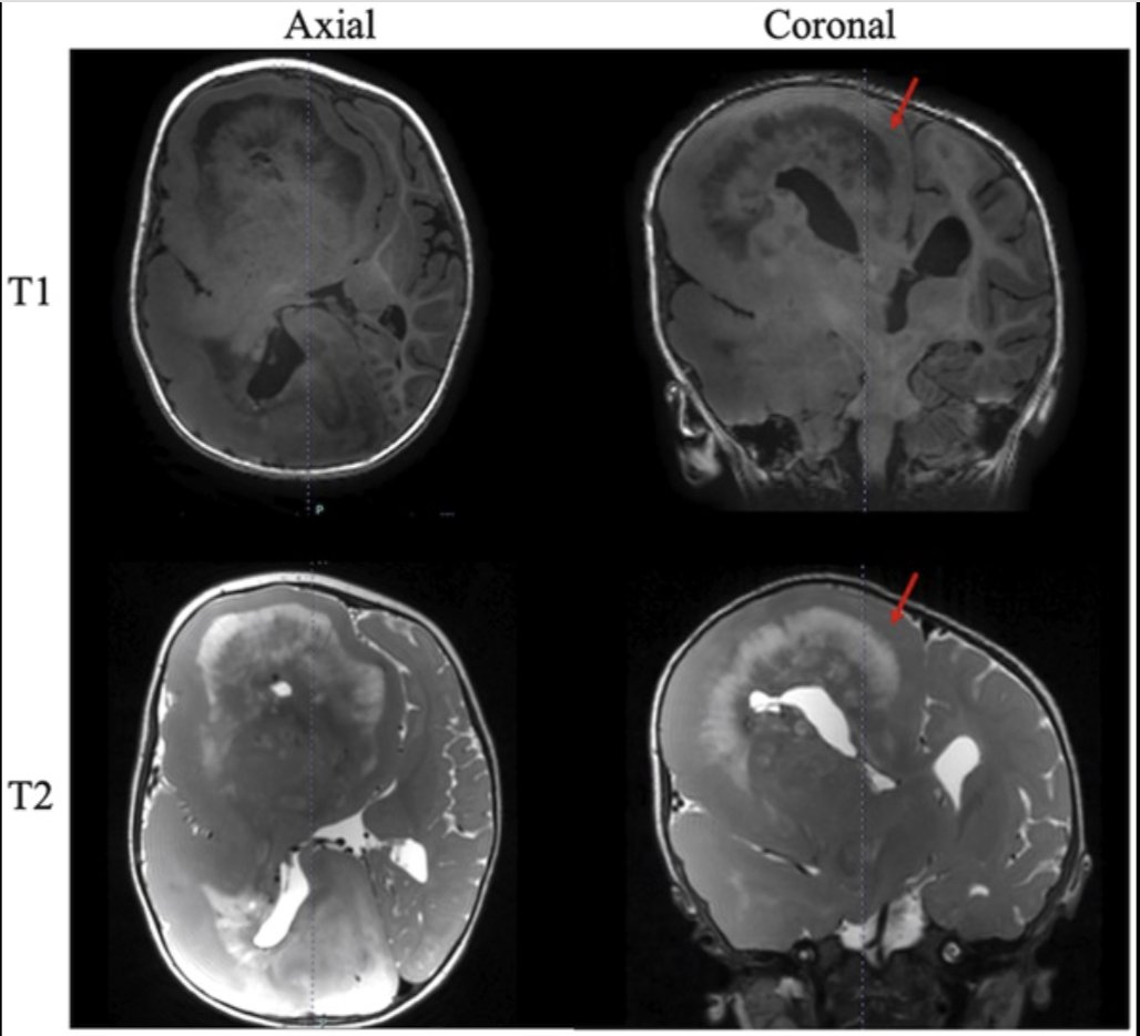 #NEUNew #NEUReview #Hemimegalencephaly: A Systematic Comparison of Functional and Anatomic #Hemispherectomy for Drug-Resistant Epilepsy bit.ly/3IU6ix8 by Goel et al @NathanShlobin @SmrutiPatelMD @CNS_Update @AliAlawiehmdphd @Zaazoue @urquiagajf_MD @e_celano @LKReedMD