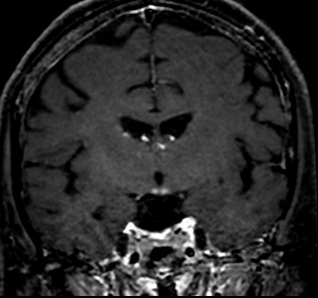#NeuroTips 💡Simmetrical mammillary bodies signal/density abnormalities and contrast enhacement can be the only feature seen in... 📌Wernicke encephalopathy