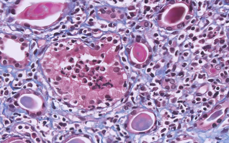 ssfarouk's tweet image. "Pus (PMN) cast" 

#KidneyTransplant #KidneyPath #TransplantFridays