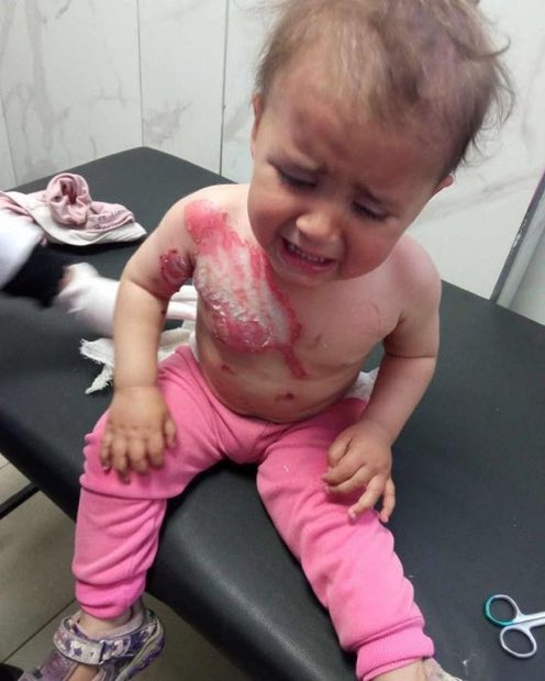 DrLoupis's tweet photo. Hi @israel.

Was this little Angel a “Hamas terrorist” since you destroyed her breast forever? 

You do realize why “Israel” is alone, right? https://t.co/eYh5W4qILI