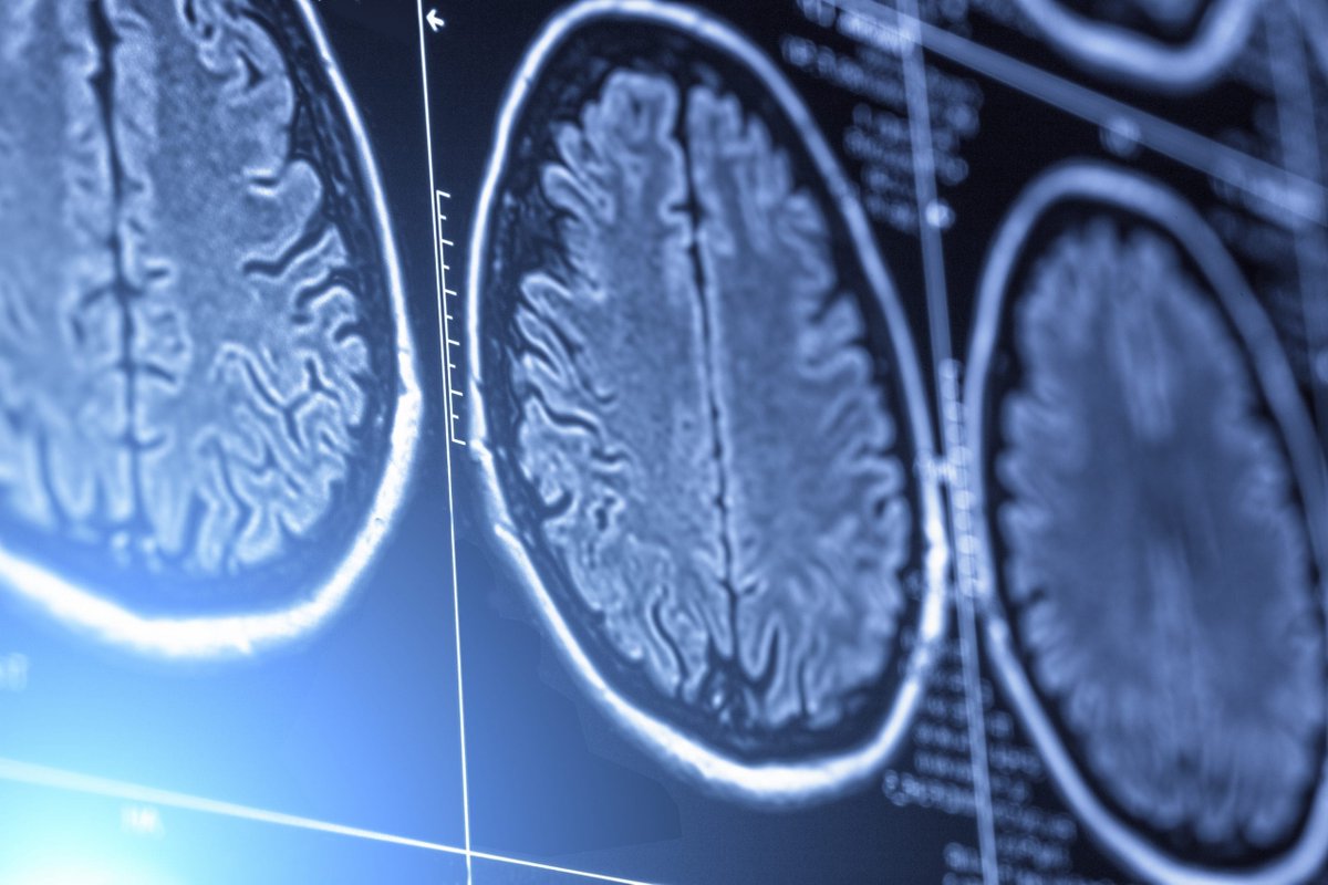 BisnarChase's tweet photo. Former NHL players Chris Simon &amp; Konstantin Koltsov's tragic suicides highlight the urgent need for brain injury awareness in hockey. This March, let's shine a spotlight on the links between the sport and CTE. It's time for action and support for affected players. #BrainInjur ... https://t.co/ZG9S0Cm3is