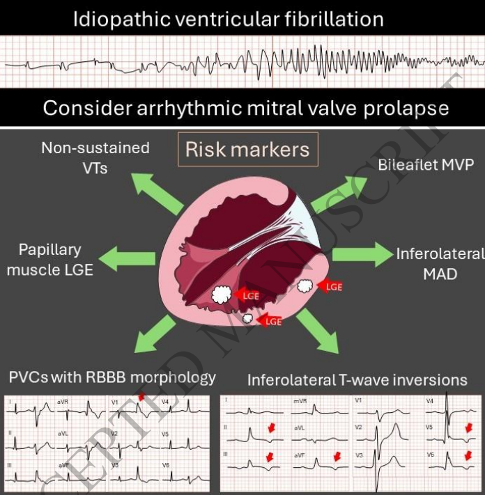Kristina Haugaa (@kristinahaugaa) on Twitter photo Are mitral valve prolapse and disjunction players in idiopathic ventricular fibrillation? @eivindaabel <a href="/ProCardio1/">ProCardioSFI</a> <a href="/ESC_Journals/">European Society of Cardiology Journals</a>
Cardiac arrest, MAD and MVP - Where there is smoke, there is a fire academic.oup.com/ehjcimaging/ar… Are mitral valve prolapse and disjunction players in idiopathic ventricular fibrillation? @eivindaabel <a href="/ProCardio1/">ProCardioSFI</a> <a href="/ESC_Journals/">European Society of Cardiology Journals</a>
Cardiac arrest, MAD and MVP - Where there is smoke, there is a fire academic.oup.com/ehjcimaging/ar…