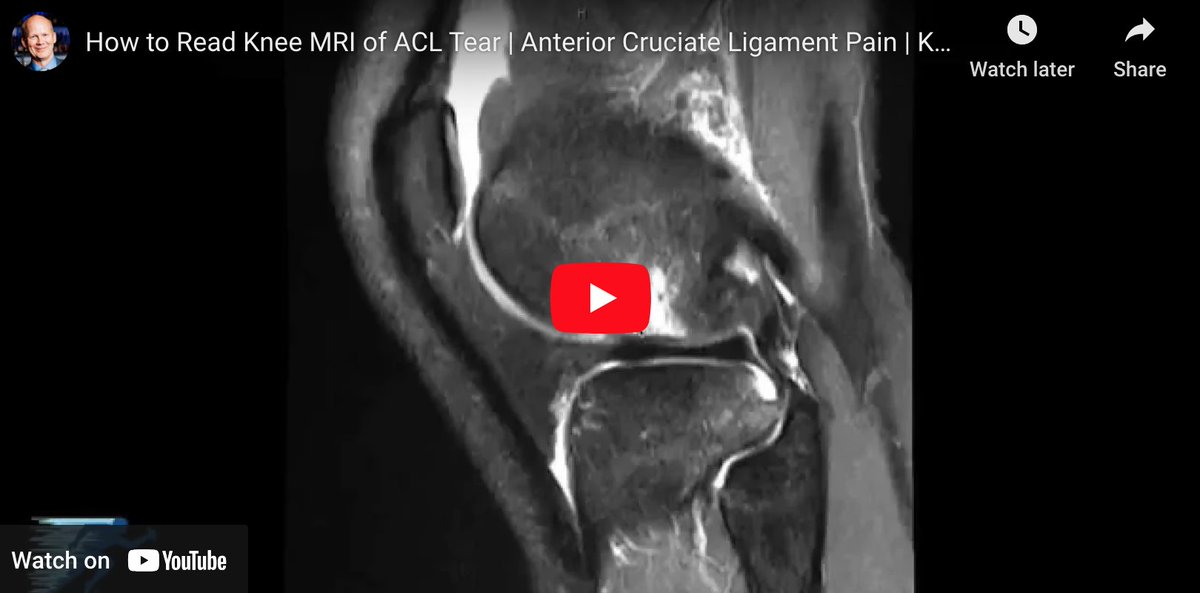 Check out this informative video by Dr. LaPrade as he explains how to read an MRI of an #ACLtear. Learn about the normal anatomy of the knee, what a torn #ACL looks like, and the secondary signs of an anterior cruciate ligament injury. medilink.us/9n5y #kneeinjury