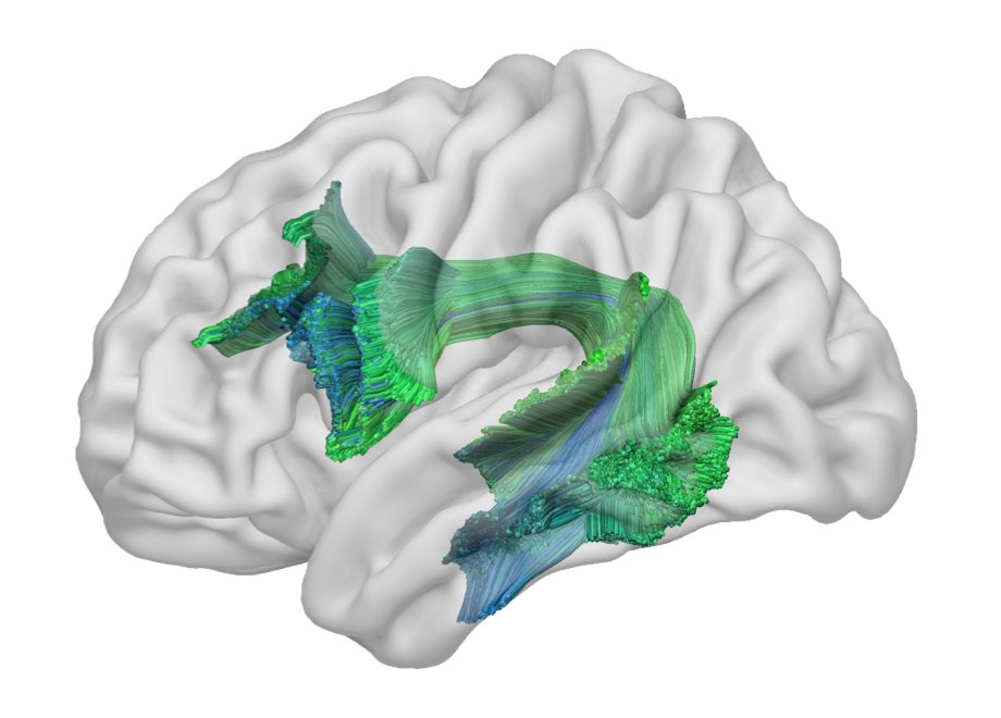 Arguably the most important white matter tract supporting human cognition. 5 things about arcuate fasciculus anatomy and an argument for its critical role in human cognition.