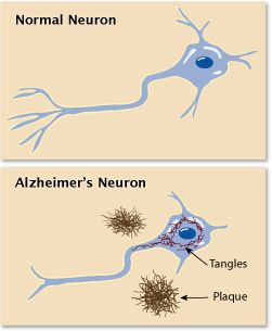 TipsCuidadores's tweet photo. Esto es lo que pasa en las neuronas cuando hay Alzheimer. https://t.co/1JF32skKyP