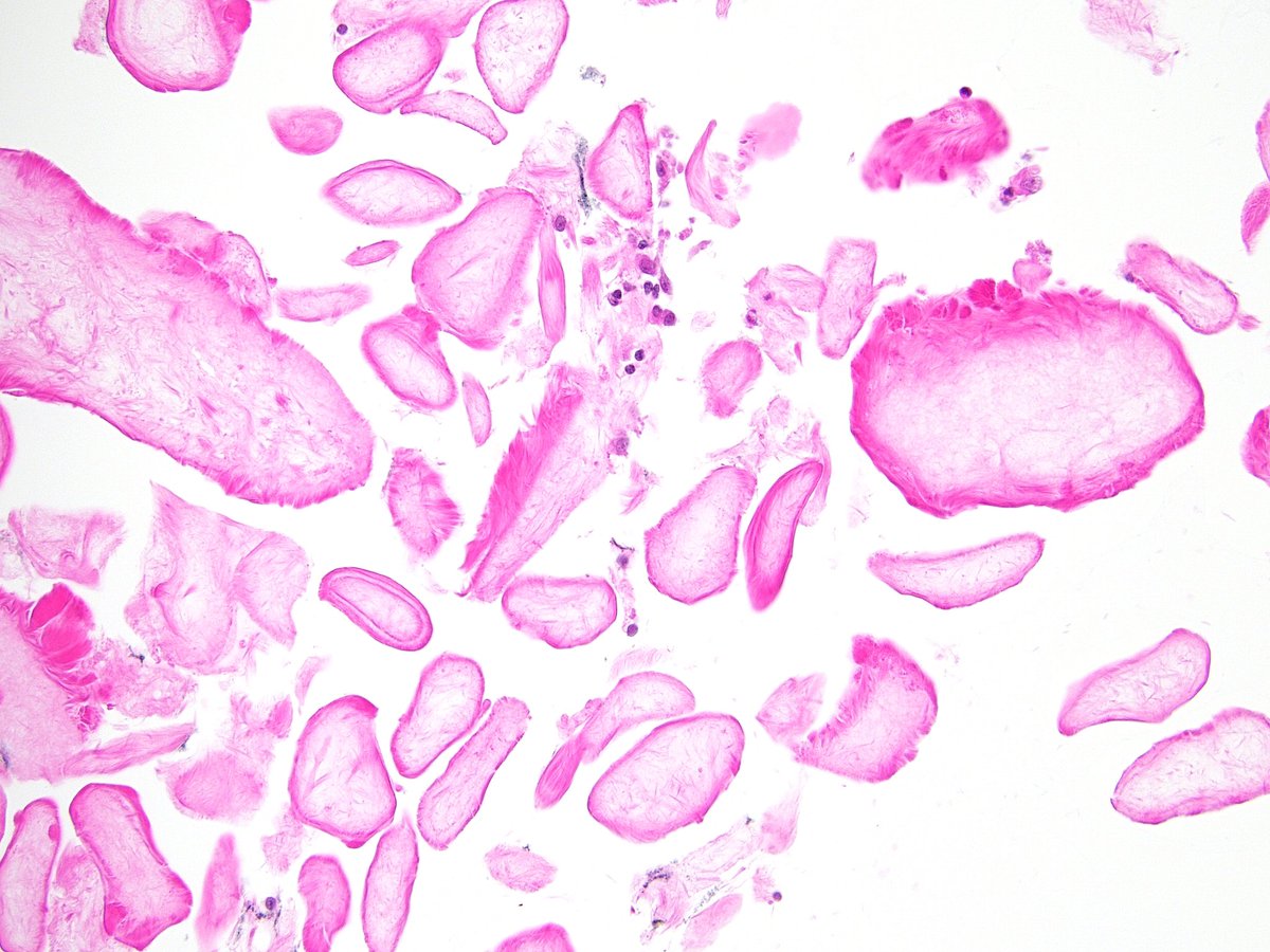 “Hairy” mucin aspirated from a Mucinous Neoplastic Cyst of the Pancreas. (Cell Block)
