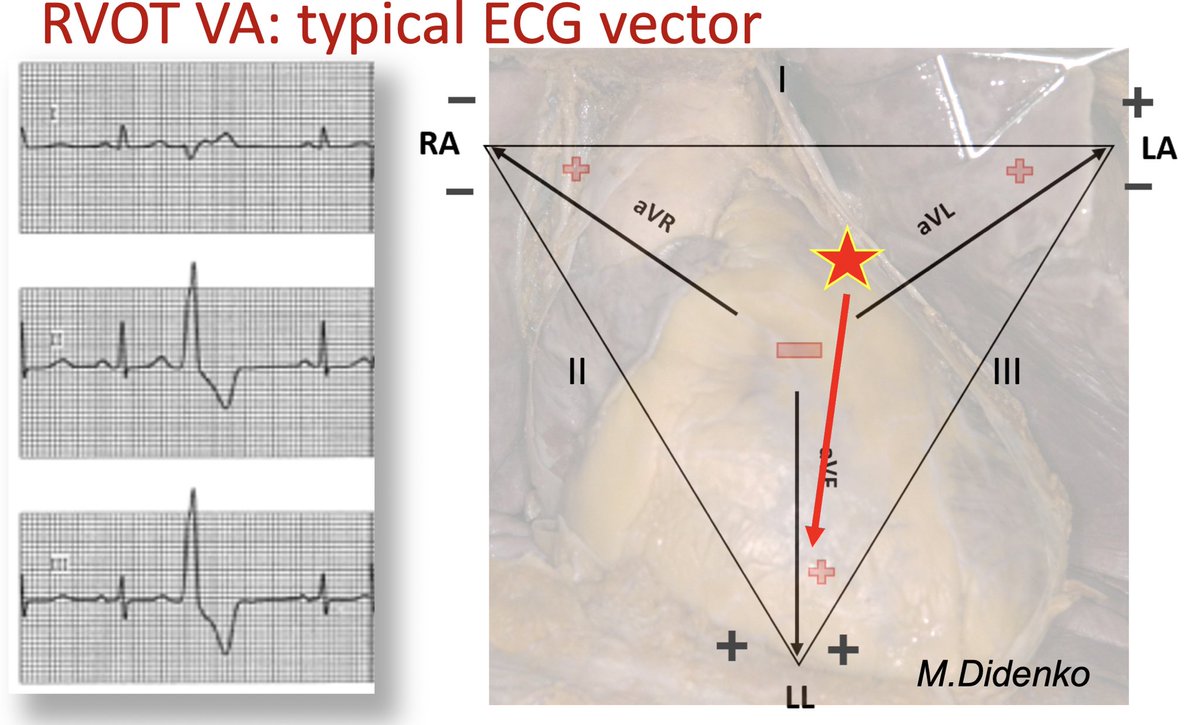 👉 Don’t miss, #EPeeps! Join us with @jacabreracardio for #Anatomy Workshop, a highlight of #EHRA2024!✅ Live demo from 8:30 till 16:30 on 8 Apr in room 7.✅ Unique session at 15:30: ❤️ anatomy for understanding of #ECG. @HdzNrw @Phiso_de @chris_sohns @GuramImnadze @melhamriti