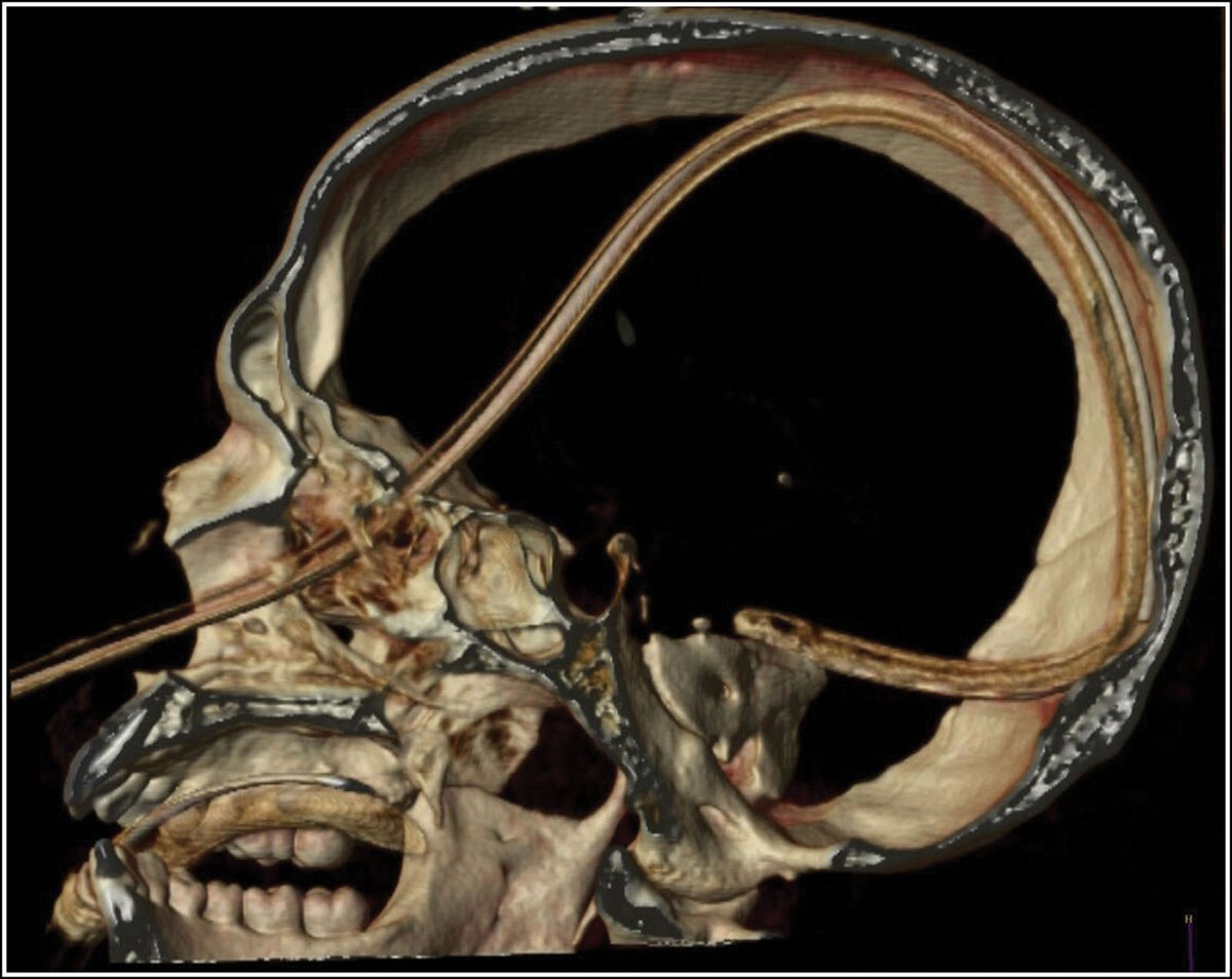 Images in #Anesthesiology - Intracranial Nasogastric Tube Placement in a Nontrauma Patient 📷 ow.ly/qmGZ50R50VW