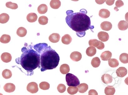 *Left: acute erythroid leukemia (formerly pure erythroid leukemia) nearly always shows bi-allelic loss of TP53
*Right: acute megakaryoblastic leukemia, variable genetics. 
Among the most aggressive forms of AML 💀 
*Both resistant to venetoclax 
#hemepath #leusm
