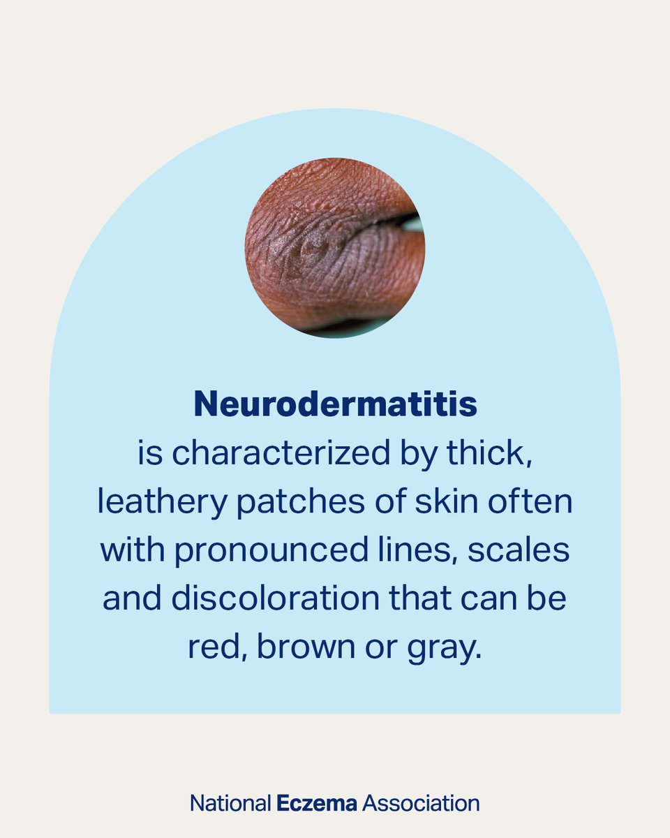 nationaleczema's tweet photo. Neurodermatitis affects about 12% of the population. Is this you?

Learn more about this incredibly itchy form of #Eczema: https://t.co/818OBXX5rp

#Neurodermatitis #GetEczemaWise #unhideECZEMA #TypesOfEczema https://t.co/nmSmmA6WPm