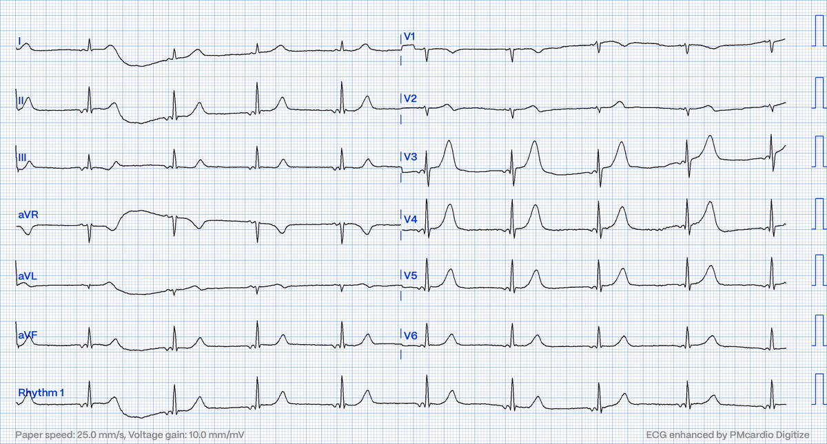 #ECG of a middle-aged man with sudden RSP. Is there a coronary culprit? If yes, is the vessel occluded and would you activate CCL? Happy Easter...