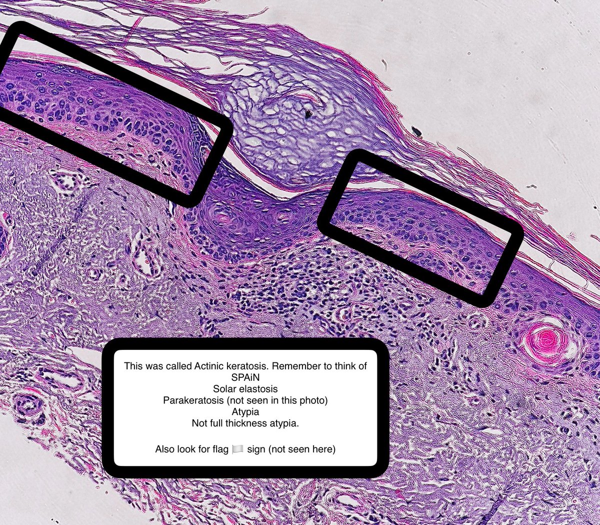 Sometimes I think seborrheic keratosis (benign) is an actinic keratosis (precancerous) 

Sometimes I think actinic keratosis is a seborrheic keratosis. 

Here is case of latter 😅😕

#pathagonia #path4people #dermpath #fammed #surgpath #dermx #derm #dermpath #dermatology #medx