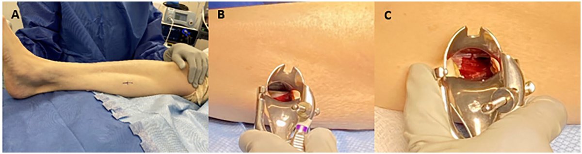 AOFAS_Journals's tweet image. Does an isolated gastrocnemius recession play a role in the treatment of insertional Achilles tendinopathy? In a small cohort group, the procedure provided relief to the patients. 13% required conversion to open debridement at mean 7 months postoperatively doi.org/10.1177/107110…