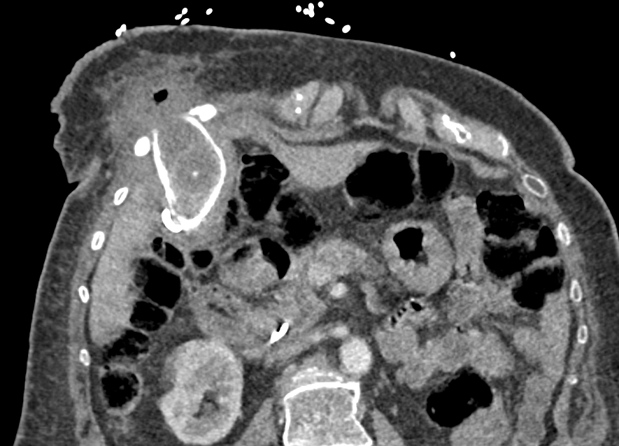 Ever seen a gallstone extending to an intercostal location? Cholecystitis with body wall abscess!!! Note: history is more complex with prior percutaneous cholecystostomy tube that was internalized.. #meded #radiology #abdrad #abdomen #imaging @SARBiliaryDFP