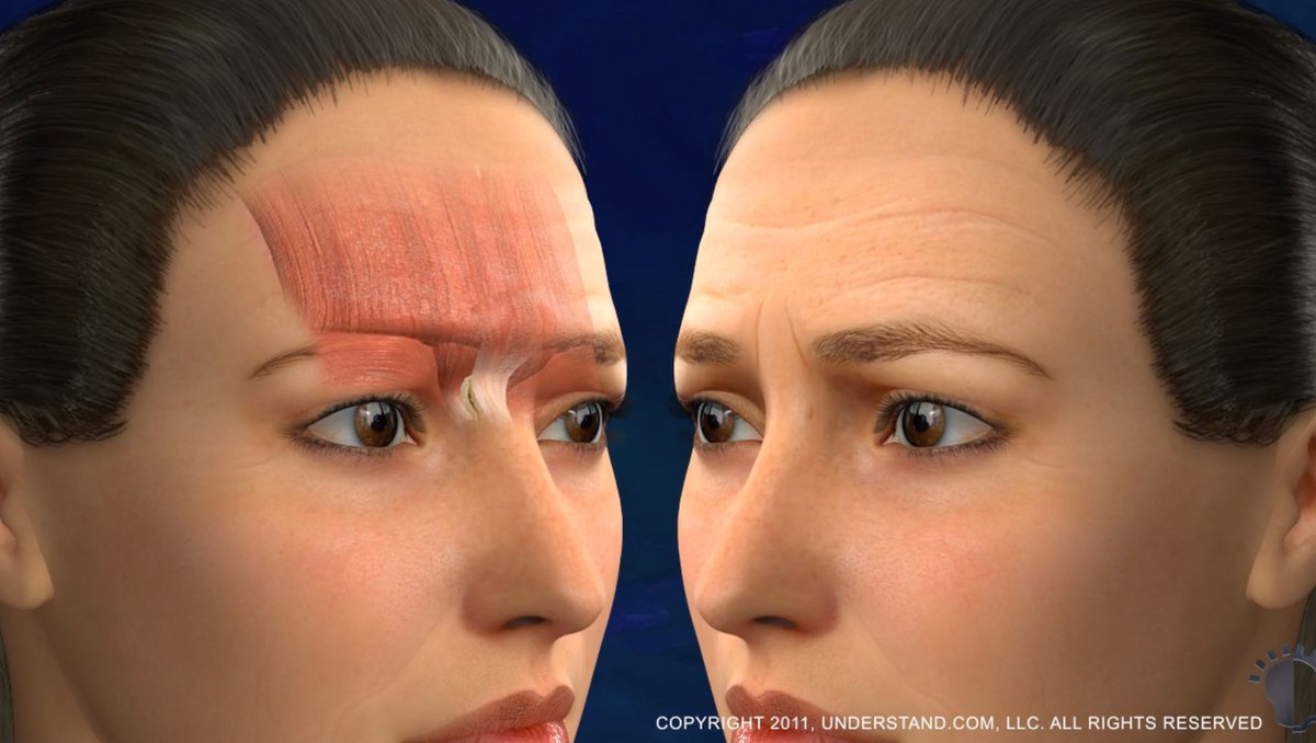 The 3D animations on our website are so informative! Find the procedure you're interested in and see what you can expect! Here is the animation of a forehead lift. buff.ly/3XYqxAc