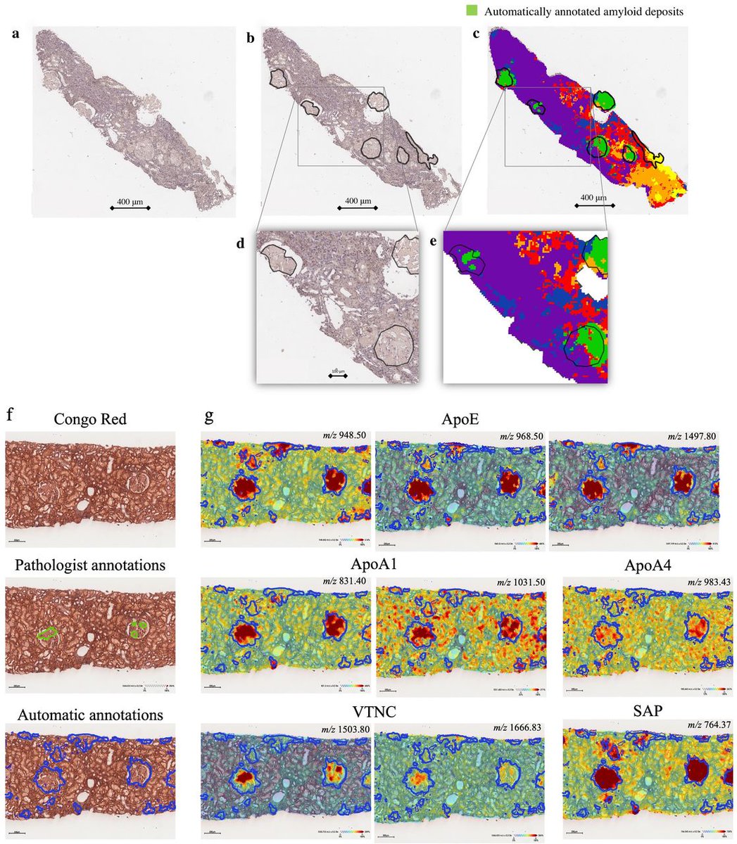 ▶️ MALDI-MSI renal amyloidosis ▶️ 16 cases amyloidosis ▶️ high sensitivity /specificity in identifying and typing known amyloid '▶️ restricted fingerprint' for amyloid detection composed of apolipoprotein E, serum amyloid protein, and apolipoprotein A1 bit.ly/3TRFPGS