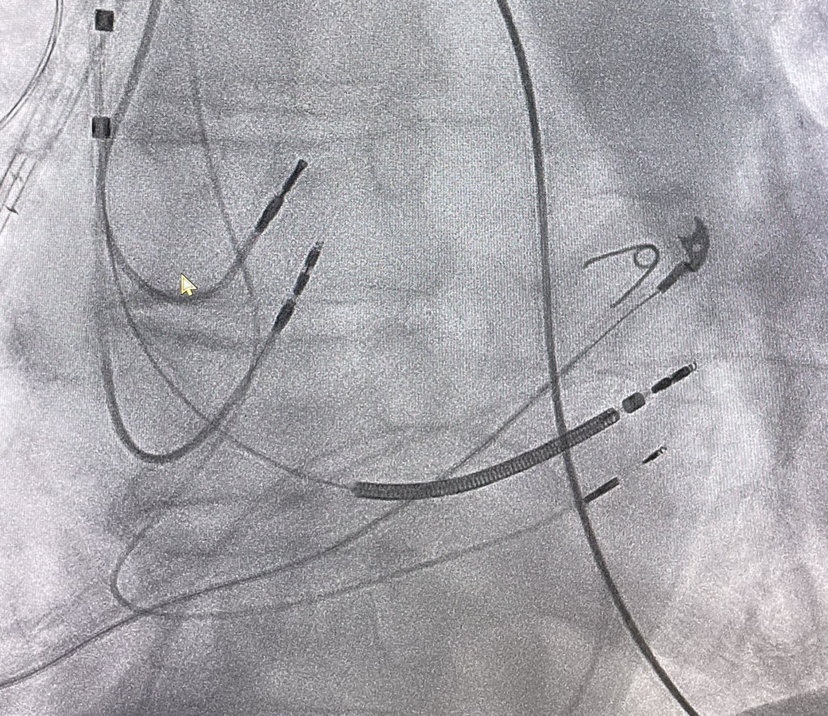 @AnandShah_MD @narrowQRS @EPWaveDoc @rdschaller @aalahmadmd @melchami99 @FaisalMMerchant We added a right sided dual pacer with #LBBAP, DDD 70, and programmed left sided ICD VVI 40. QRS 191ms==>138ms @EPLabDigest @AmoleOjoMD @Drdevignair #EPeeps #CardioTwitter