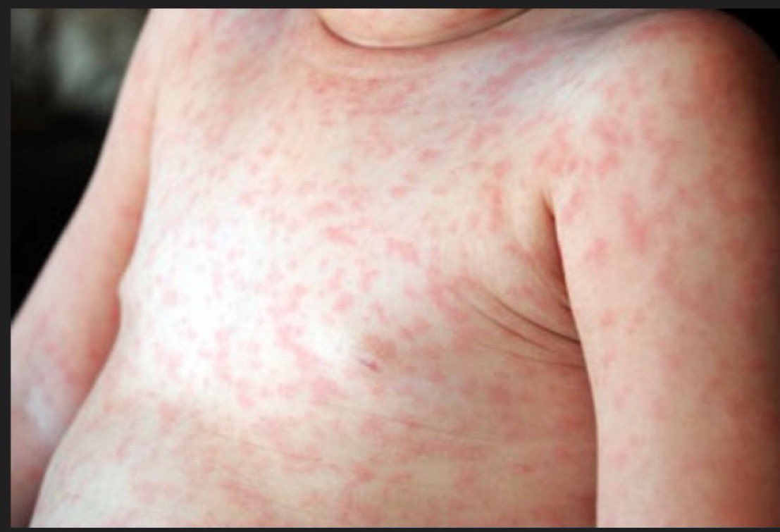 A 9-month old girl p/w high grade fevers for 3 days. She has been more irritable but has been eating. This morning, she no longer had a fever but developed a pink blanchable rash over her chest & back. Exam w/ erythematous papules on her soft palate. What is the likely diagnosis?